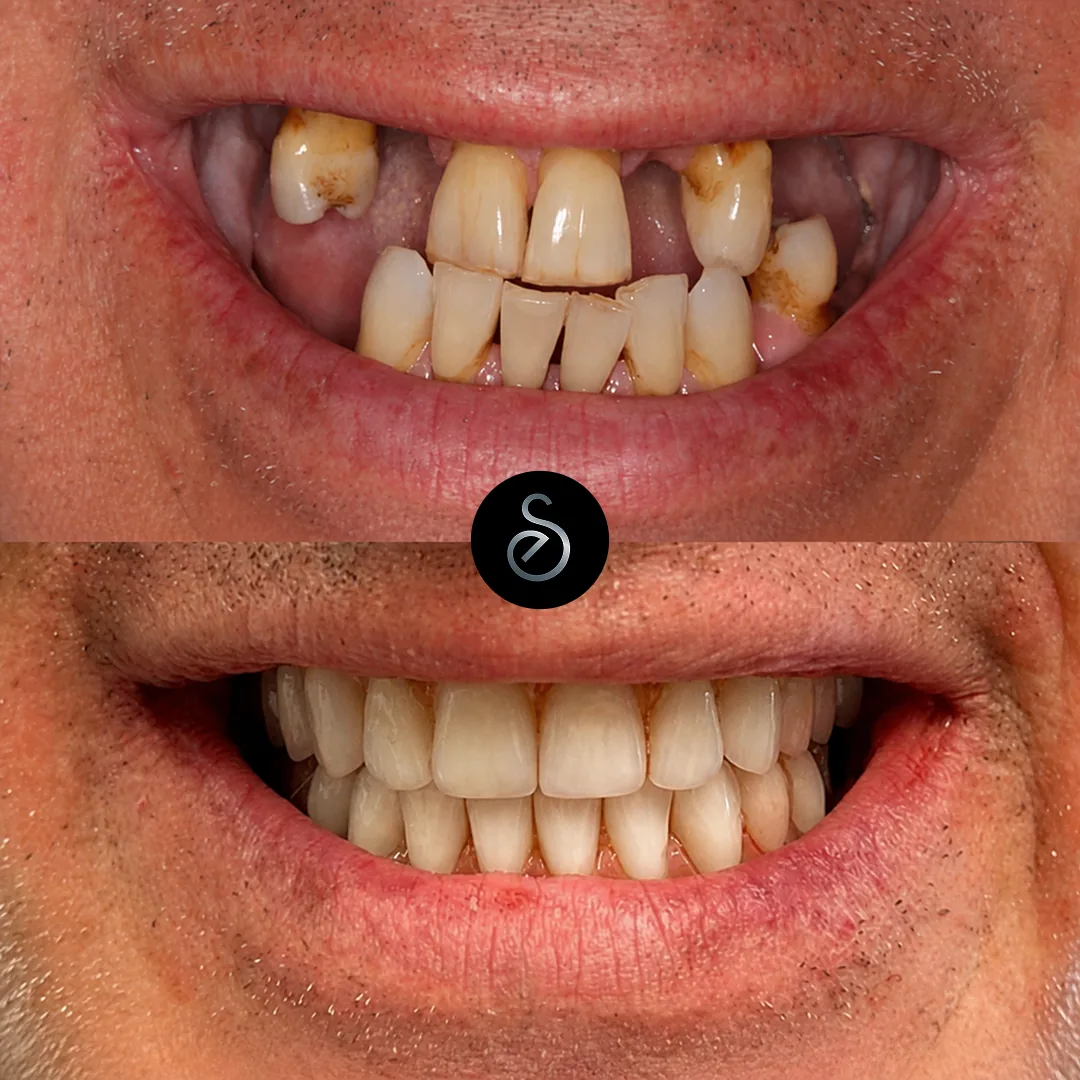Before and after emergency dental treatment at Elegant Smiles