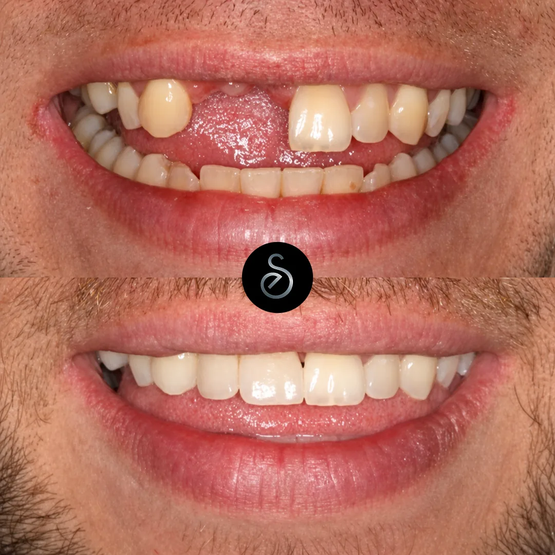 Before and after emergency dental treatment at Elegant Smiles