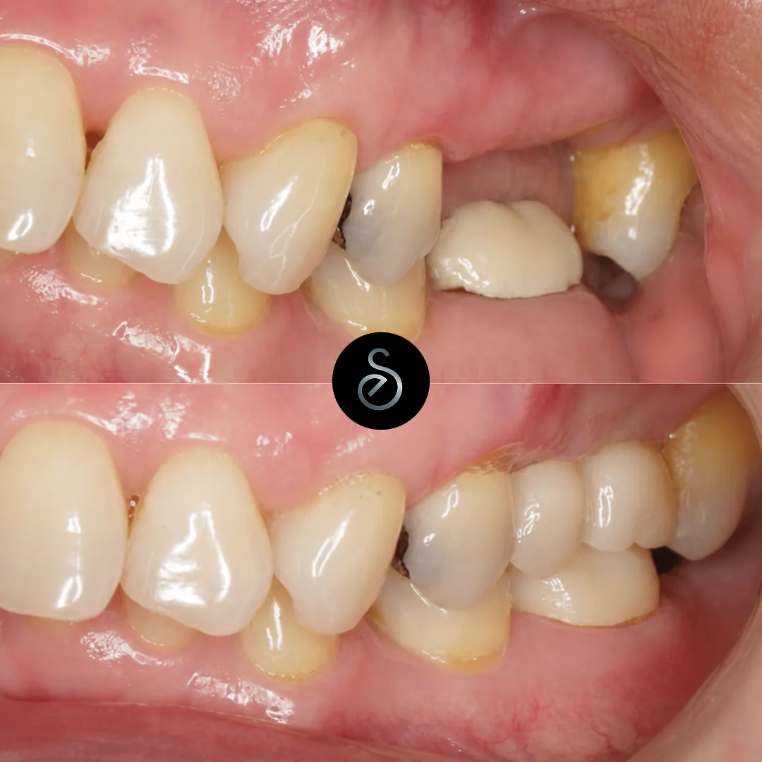 Before and after emergency dental treatment at Elegant Smiles