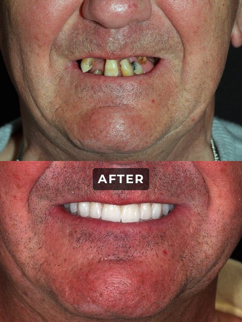 An Elegant Smiles implant patient, before and after