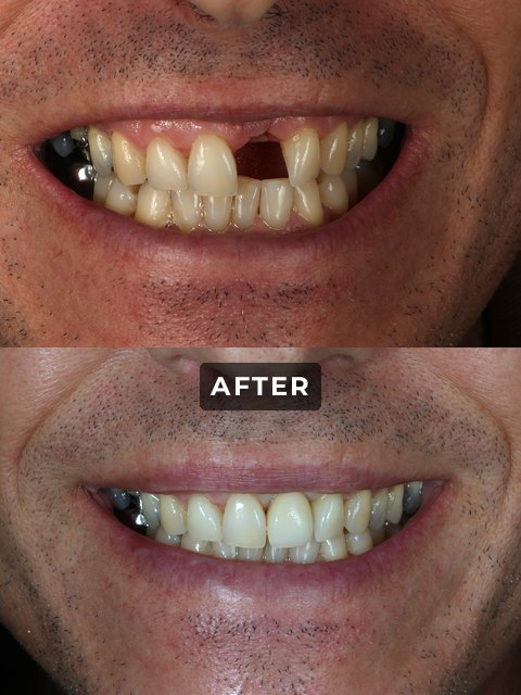 An Elegant Smiles implant patient, before and after