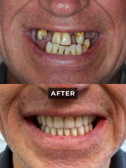 An Elegant Smiles implant patient, before and after