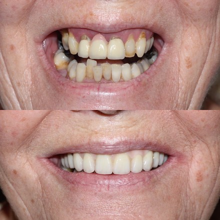 Before and after an Invisalign case at Elegant Smiles