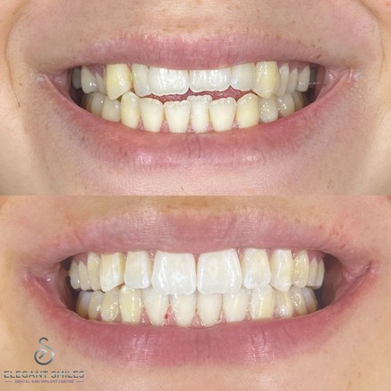 Before and after an Invisalign case at Elegant Smiles