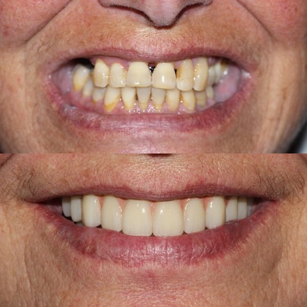 Before and after an Invisalign case at Elegant Smiles