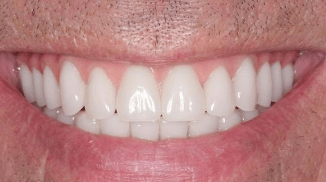 After - Appoline Dental Care