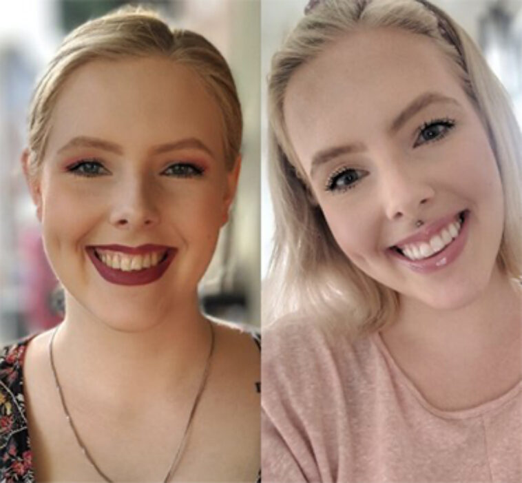 Invisalign Result - Before and After