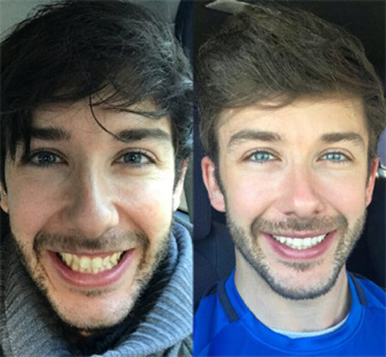 Invisalign Brace - Before and After